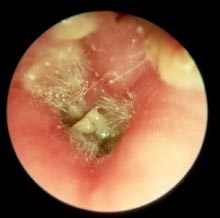 Улучшение диагностики и лечения грибковых инфекций может предотвратить более миллиона смертей от СПИДа к 2020 году