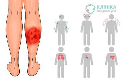 Поздний сепсис подавляет иммунную систему