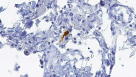 альцгеймера